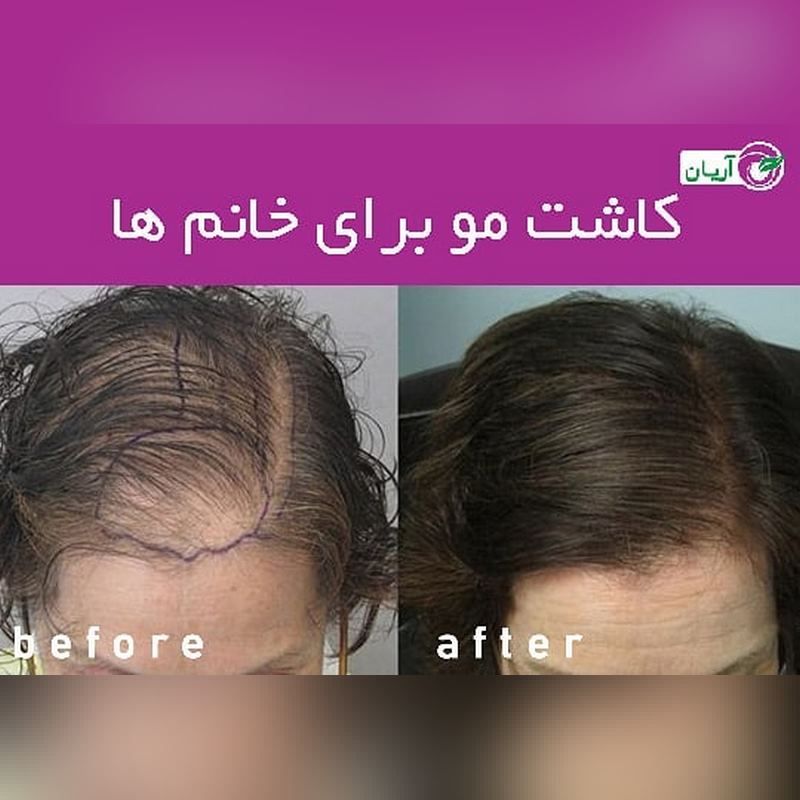 گالری کاشت مو 